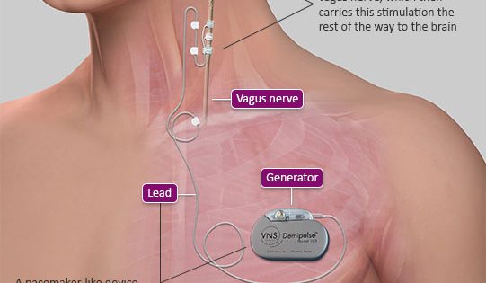 How VNS Therapy for Epilepsy Works| Cyberonics | Blog #42