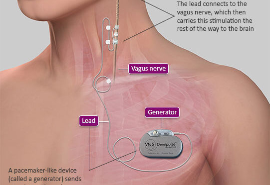 How VNS Therapy for Epilepsy Works| Cyberonics | Blog #42